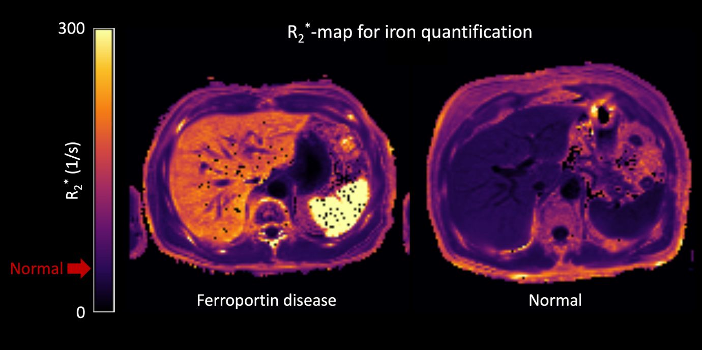 MRT R2* Eisenquantifizierung mit Eisenüberladung von Leber und Milz bei einem Patienten mit Ferroportinerkrankung (Foto: Univ.-Klinik für Radiologie/Ch. Kremser) Ferroportin.jpg
