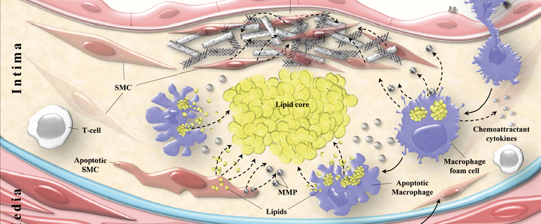 NEWS_Arterie_Lipide.jpg