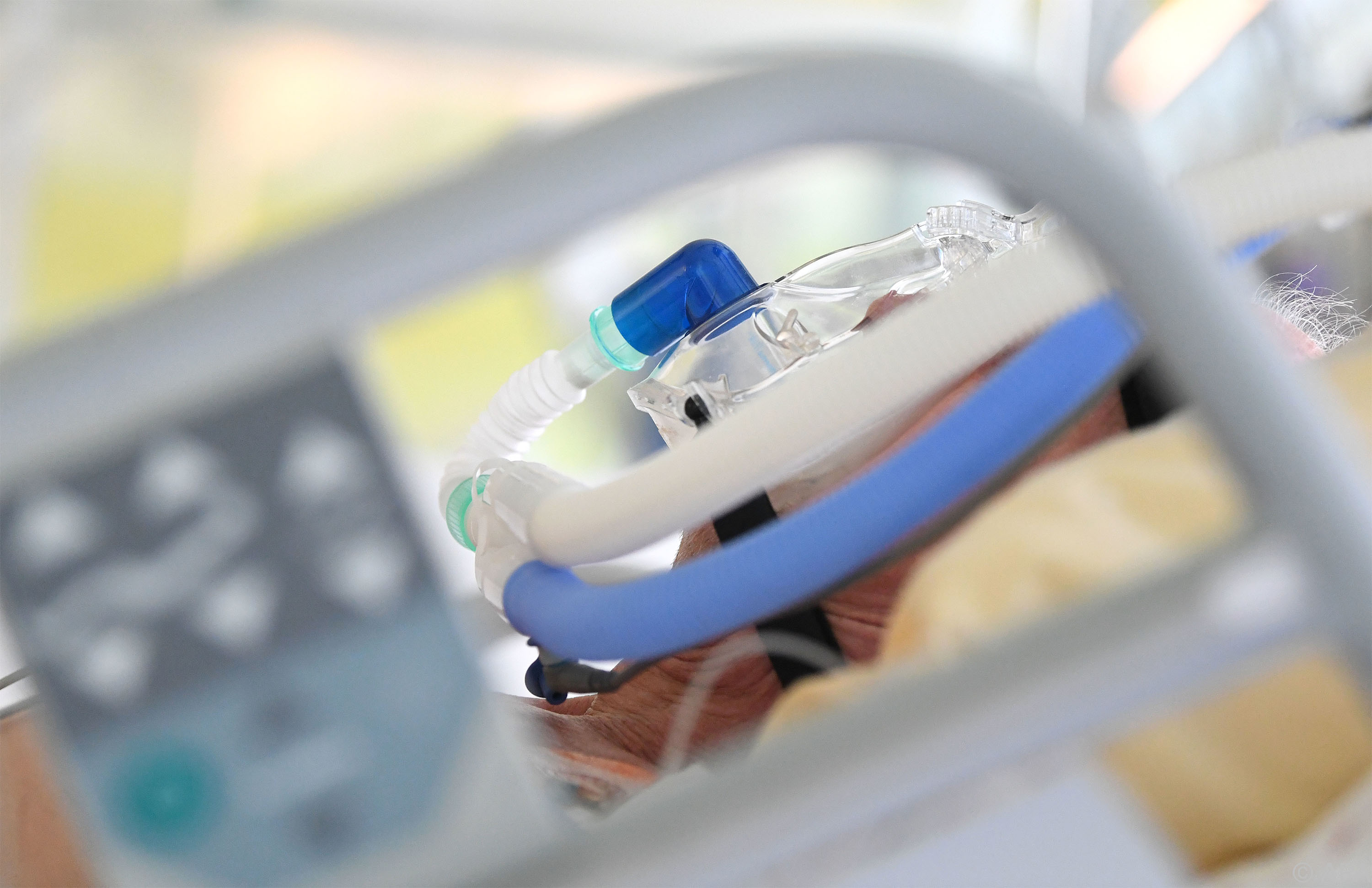 Muskelschäden durch Covid-19 nur in Ausnahmefällen