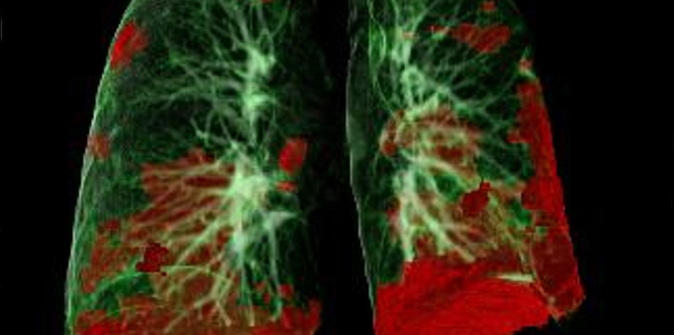 Innsbrucker Langzeitstudie zu COVID-19 mit erfreulicher Zwischenbilanz: Schwer Erkrankte profitieren von langfristiger und interdisziplinärer Nachsorge