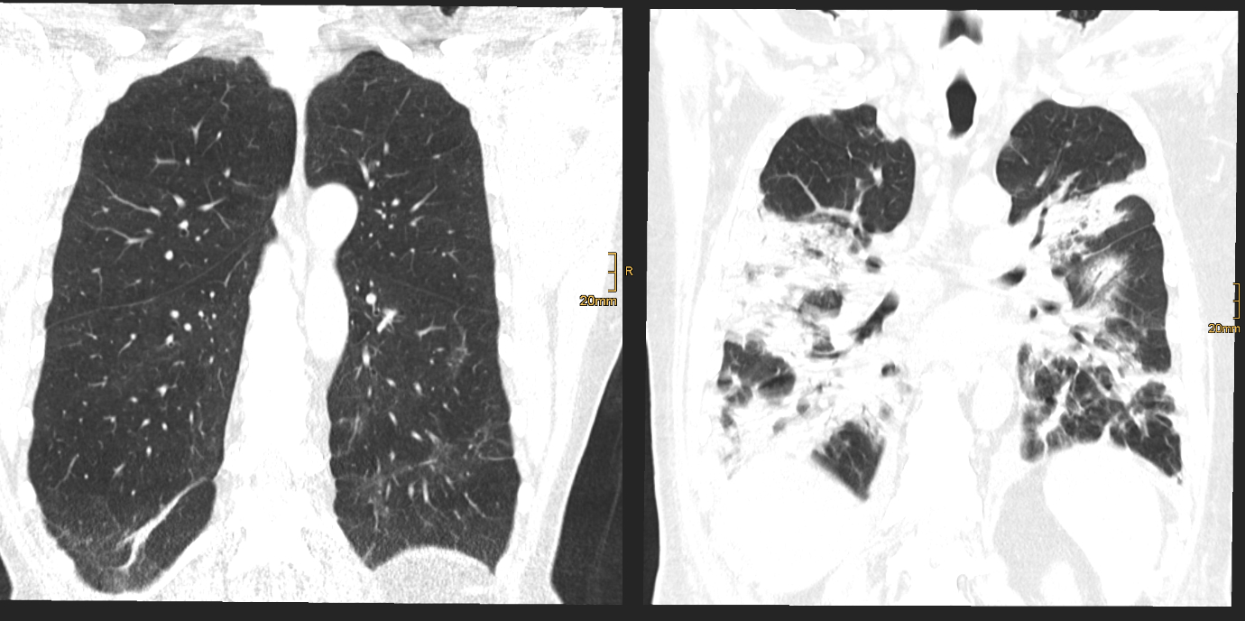COVID-19 und das Risiko für anhaltende Lungenveränderungen