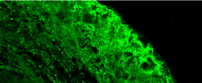 Immunfluoreszenztest an Gefrierschnitt von Bindegewebskapsel um Silikonbrustimplantat. Nachweis des nicht-kollagenen Bindegewebsmoleküls Fibronektin in der Nachbarschaft des Implantats (schwarzes Areal rechts oben). Originalvergrößerung x400 (Abbildung aus Publikation Annual Review of Immunology)