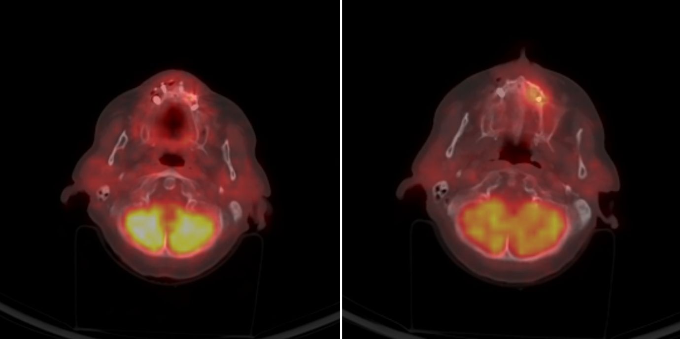 Risiko für Kiefernekrosen bei der Therapie von Knochenmetastasen kann im Schnitt 238 Tage vorausgesagt werden