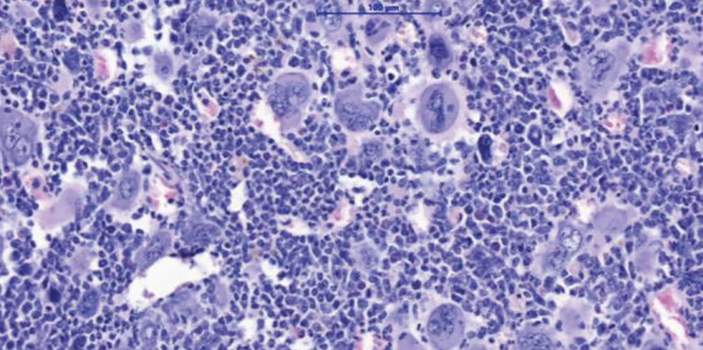 NLRP3 treibt chronischen Blutkrebs an