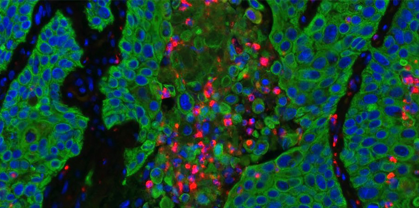 Erster hochauflösender Einzelzell-Atlas zum Lungenkarzinom