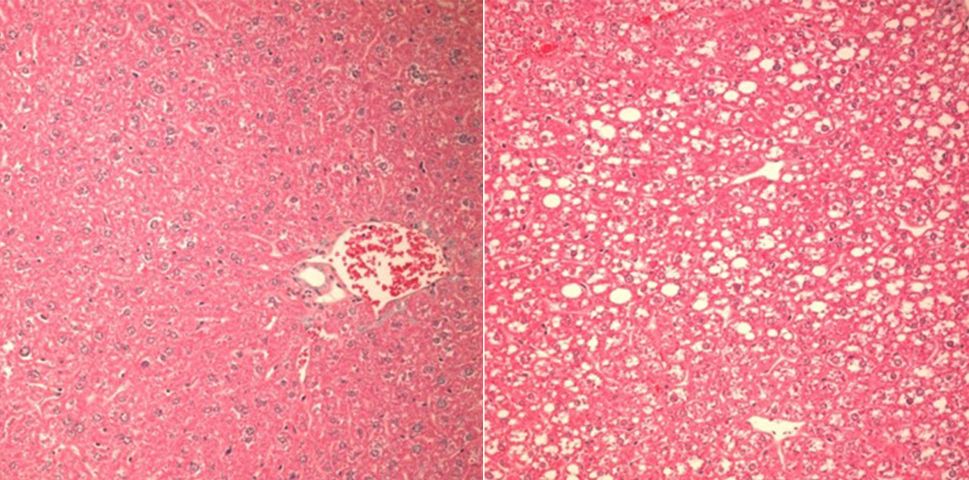 Von der Fettleber zur Leberentzündung