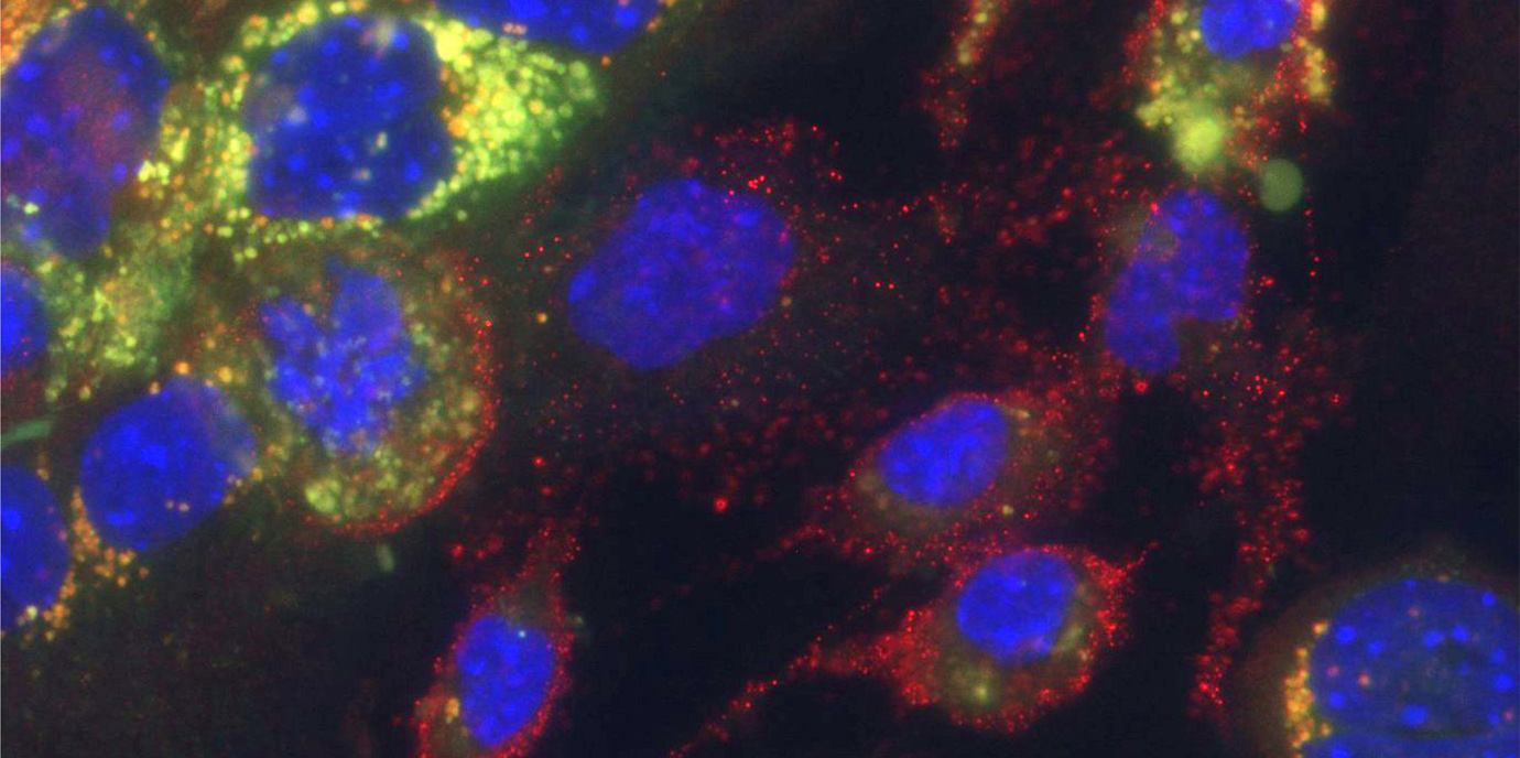 Schützt Eisen vor Atherosklerose?