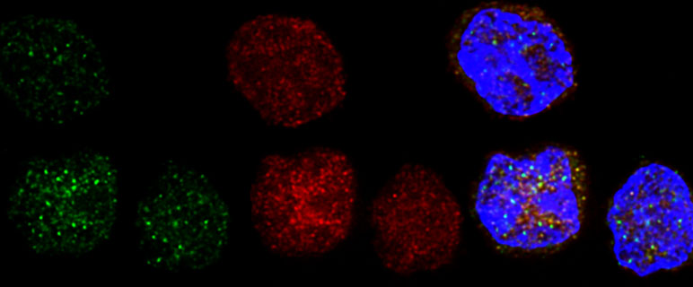 DNA Schädigung in gestressten haematopoetischen Stammzellen (Links - Grün: DNA-damage Foci, gammaH2AX; Mitte - Rot: Sensor von DNA Schäden, pATM; Rechts – Blau: Overlay plus DNA)