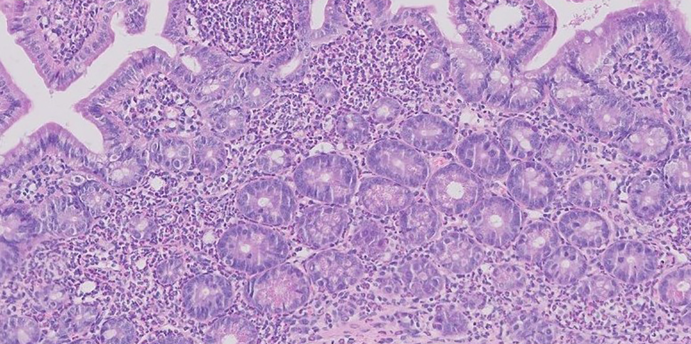 Mehrfach ungesättigte Fettsäuren lösen Morbus Crohn ähnliche Darmentzündung aus