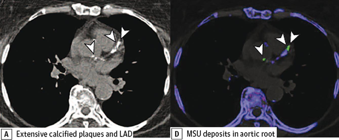 Neues Verfahren zur Erkennung von Harnsäureablagerung