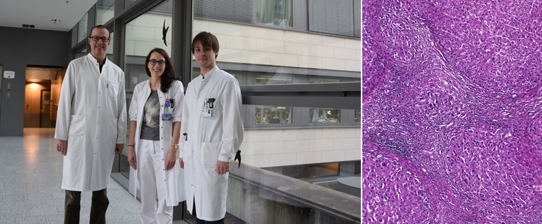 Neuer Therapieansatz für schwere alkoholbedingte Leberentzündung