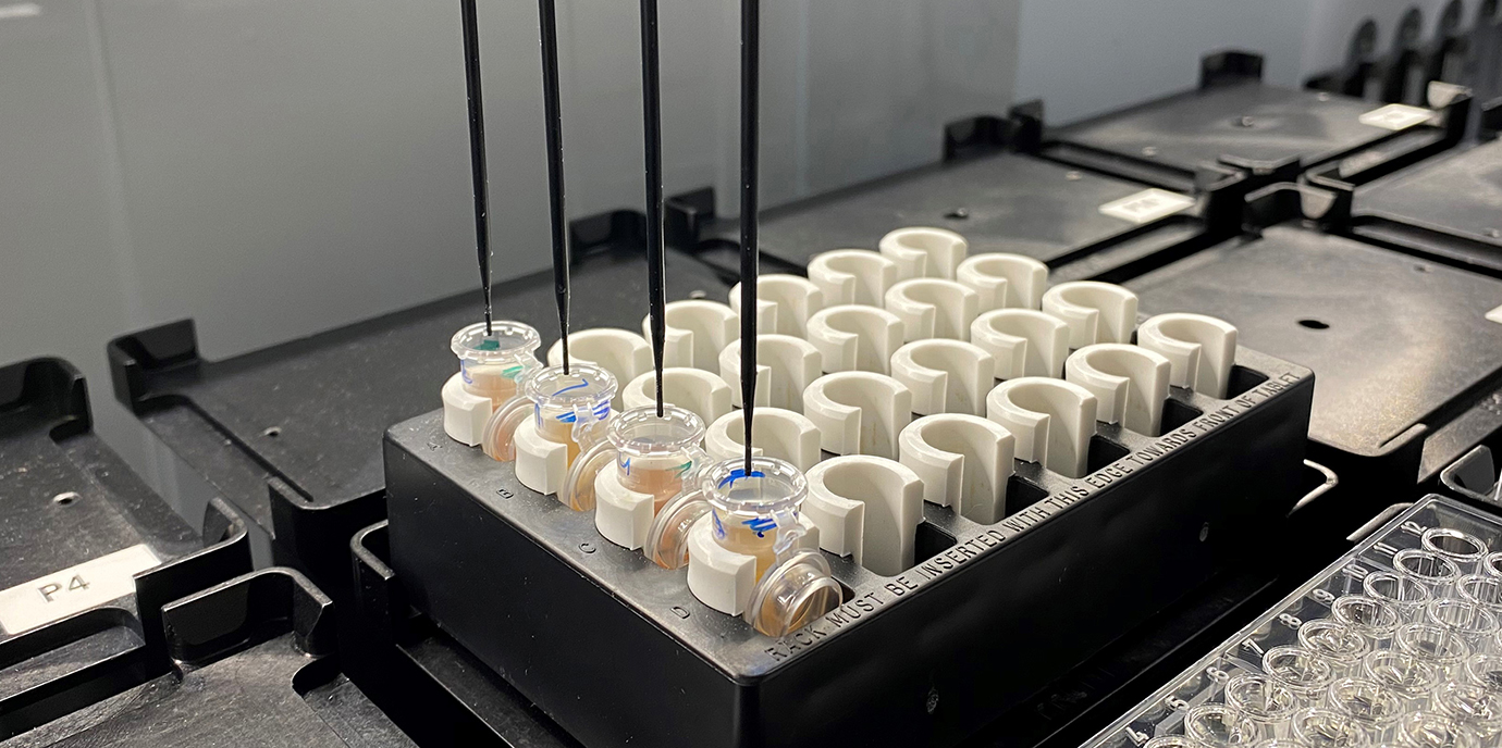 Häufige Lp(a)-Genmutation reduziert Herzinfarkt-Risiko