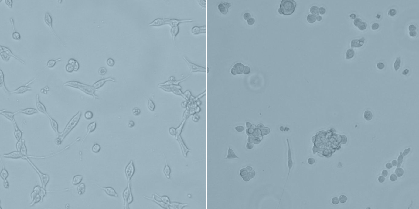 Neuer therapeutischer Angriffspunkt für Prostatakrebs entdeckt
