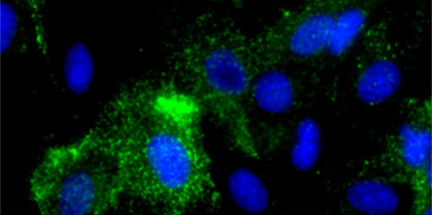 Plasmapherese: Eine vielversprechende Zusatztherapie bei Sepsis