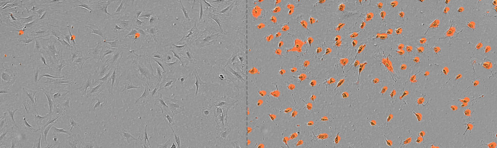 Die Abbildung zeigt unbehandelte Grm1-positive Melanomzellen auf der linken Seite sowie rechts Zellen, die mit L-Buthionin-(S,R)-Sulfoximin (L-BSO), einem Inhibitor des Glutamatstoffwechselwegs, behandelt wurden. Die rote Fluoreszenz markiert sterbende oder tote Zellen. (Bild: Metabolic inhibition of glutamate-cysteine ligase increases dendritic cell-mediated antitumor immunity in melanoma. Journal for ImmunoTherapy of Cancer. 2026;14:e014808. https://doi.org/10.1136/jitc-2026-014808)