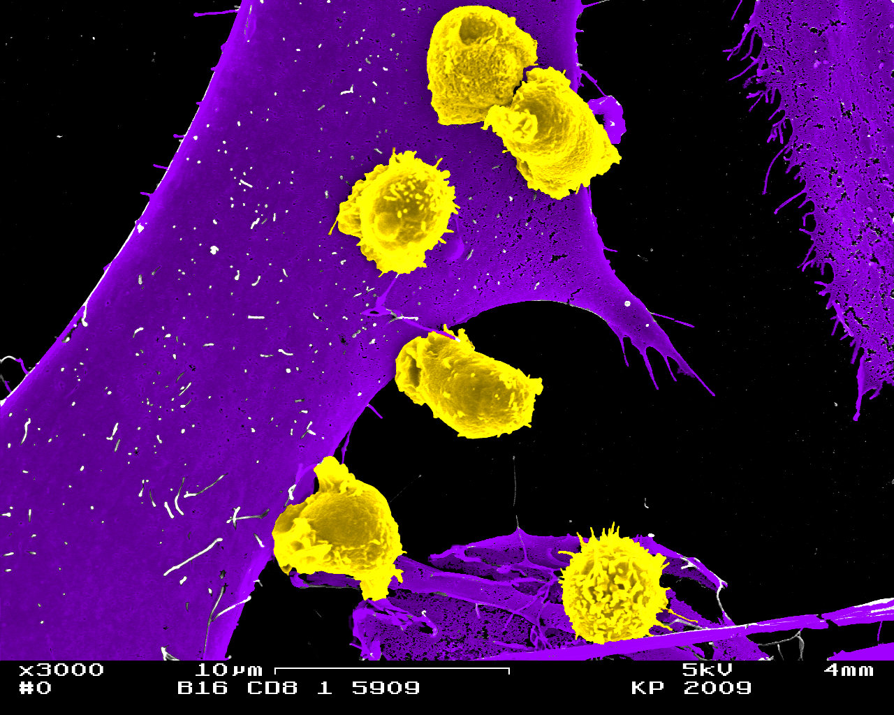 Killer T Lymphozyten (kleine Zellen) erkennen und zerstören eine Tumorzelle (groß)