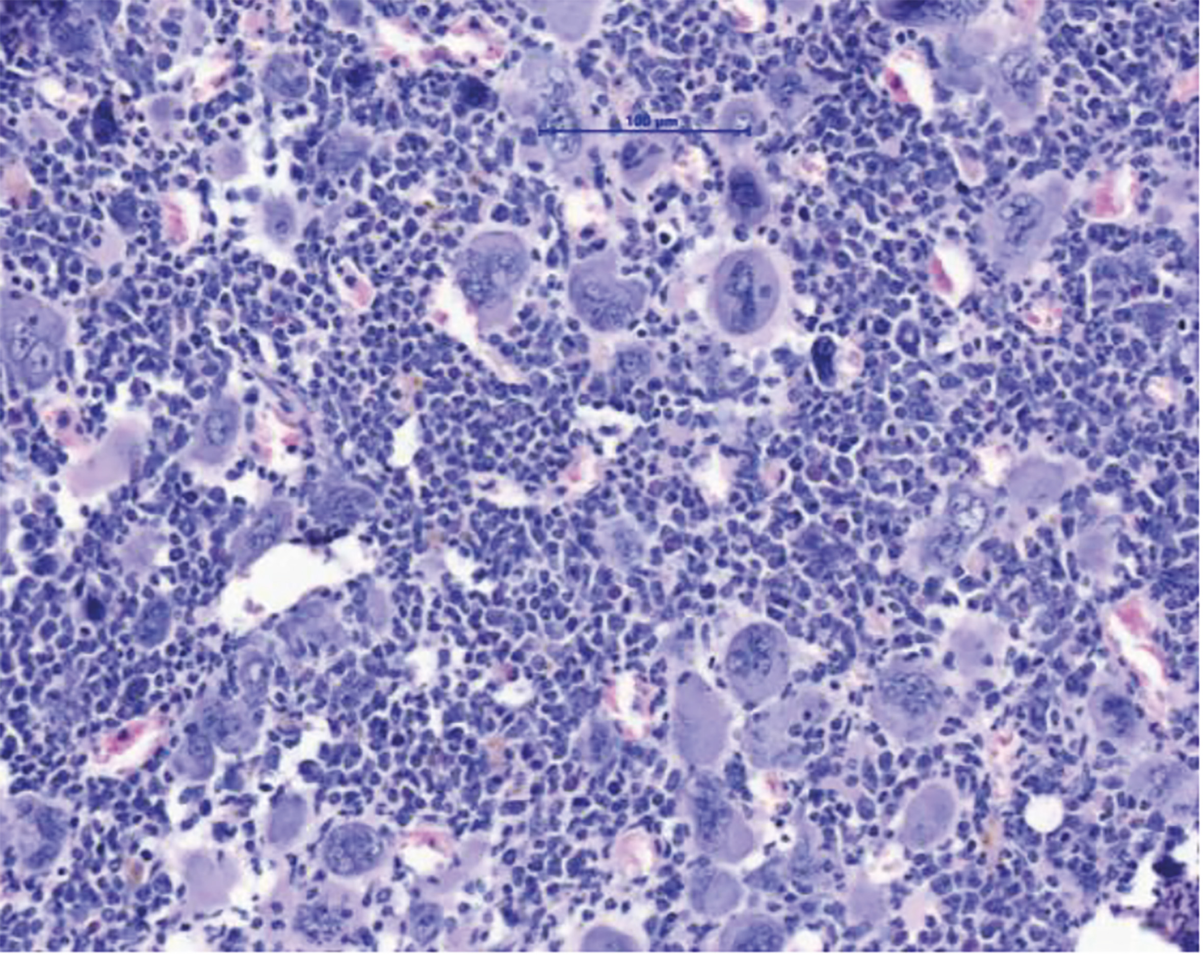 MPN sind durch eine Expansion des blutbildenden Systems im Knochenmark charakterisiert. Dies führt zum Anstieg verschiedener Zellreihen und im Endzustand dann zur Knochenmarksvernarbung und auch akuten Leukämie. (Grafik: MUI/Univ-Klinik für Innere Medizin V)